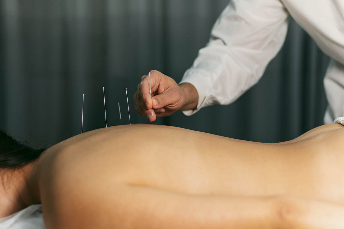 What Are The Difference Between Dry Needling and Acupuncture