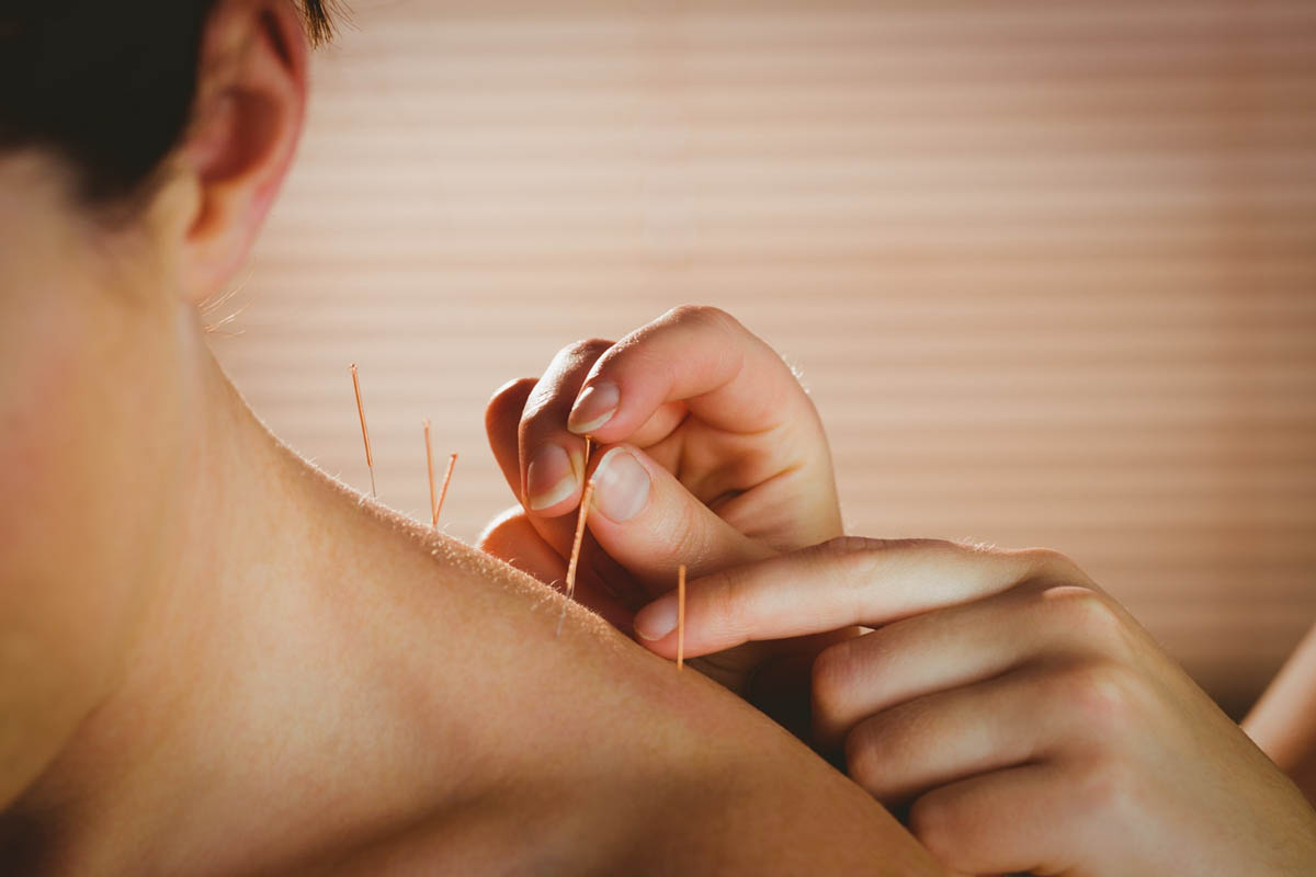 Dry Needling vs. Acupuncture: Which is Better?