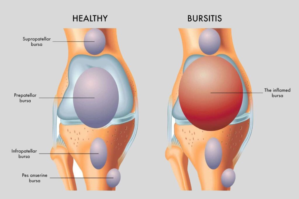 Bursitis: What is it, What are the Symptoms, and How Can it Be Treated?