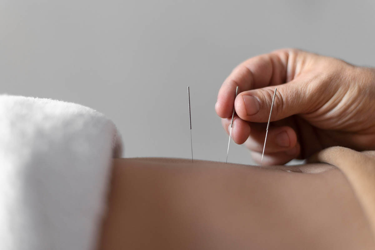 Introduction to Dry Needling