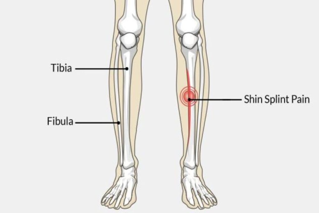 Understanding Shin Splints: Causes, Treatment, and Prevention