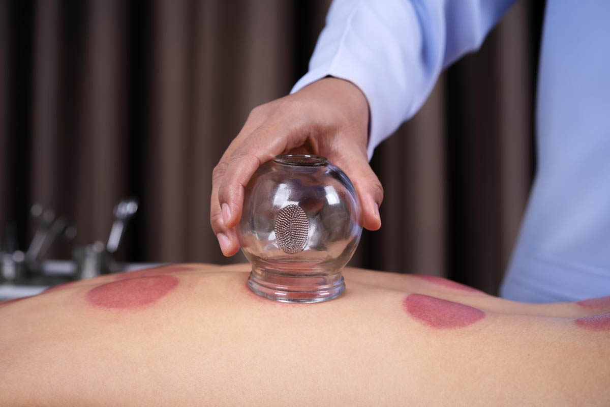 Should You Do Cupping Before or After Workout Recovery